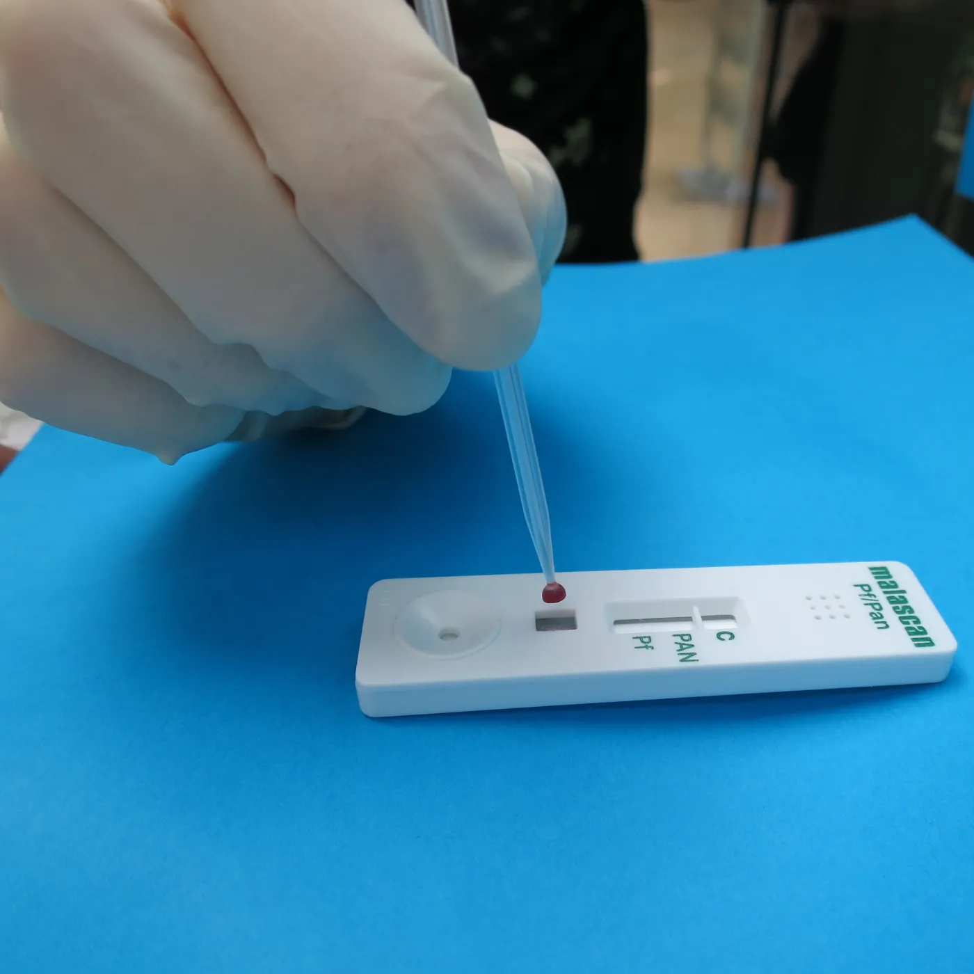 A malaria rapid diagnostic test (RDT)