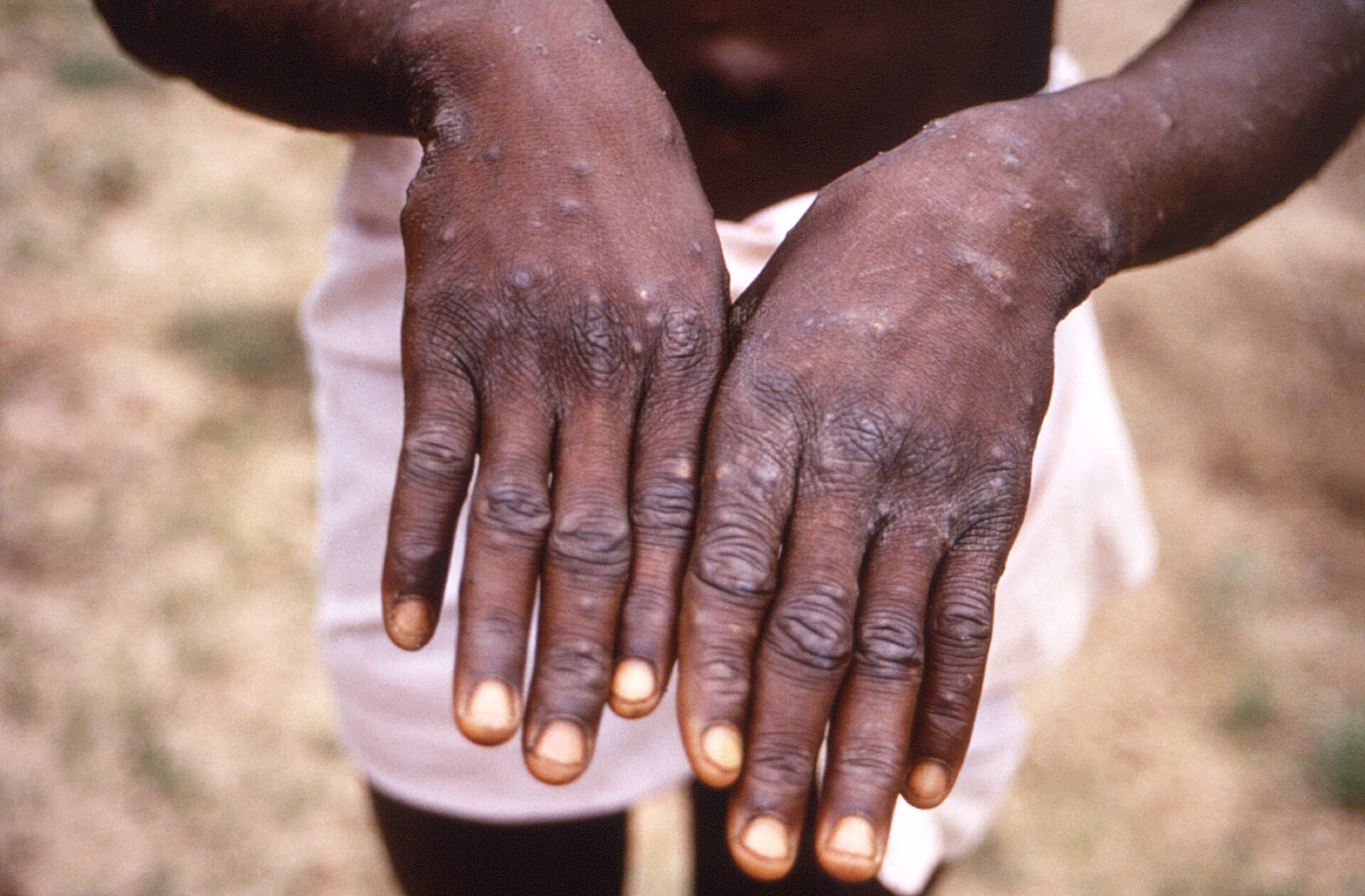 This 1997 image was created during an investigation into an outbreak of mpox, which took place in the Democratic Republic of the Congo (DRC), formerly Zaire, and depicts the dorsal surfaces of the hands of a mpox case patient, who was displaying the appearance of the characteristic rash during its recuperative stage. Even in its stages of healing, note how similar this rash appears to be when compared to the recuperative rash of smallpox, also an Orthopoxvirus.